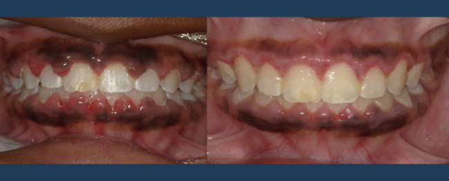 Close-up before-and-after photo of laser gum depigmentation/hyperpigmentation removal