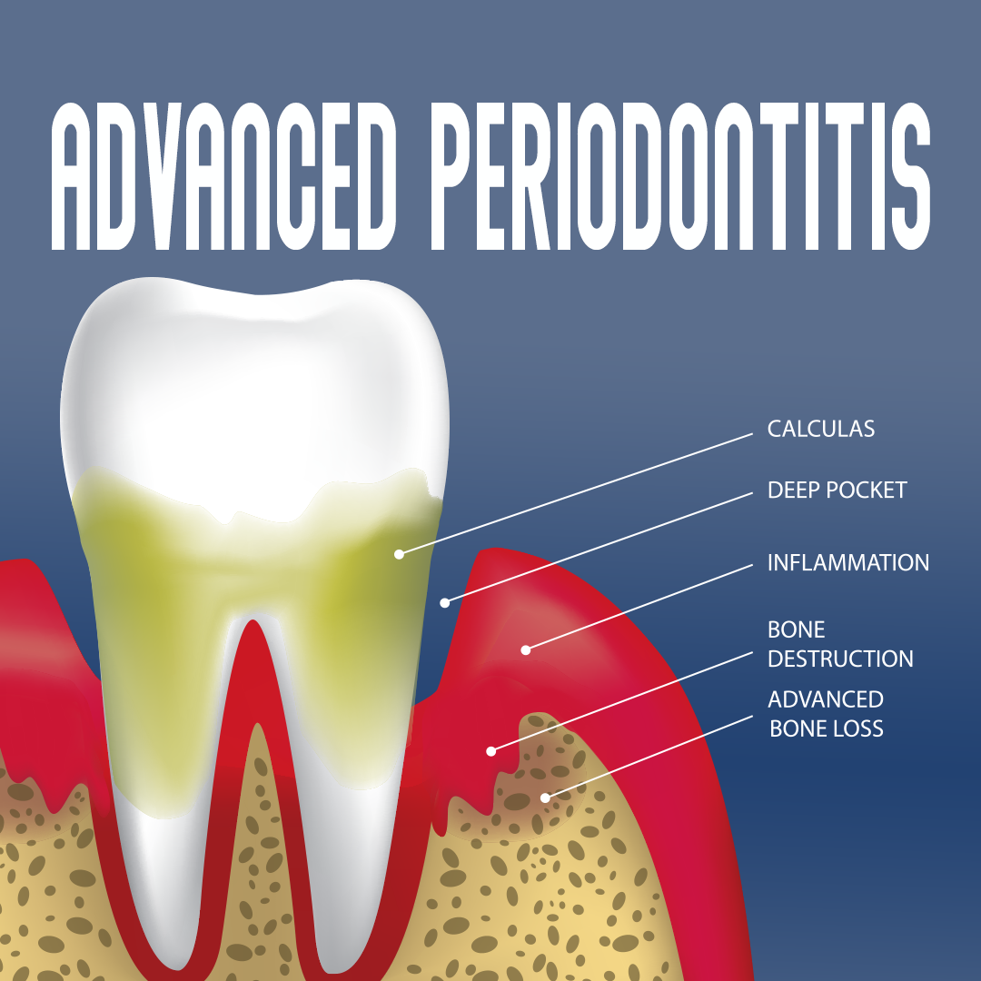 anatomy of advanced periodontitis