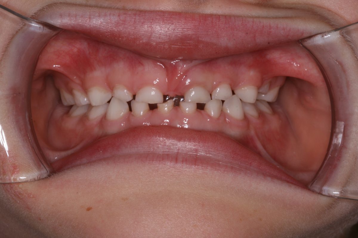 Front view of a child’s primary teeth showing severe wear and shortened crowns from grinding