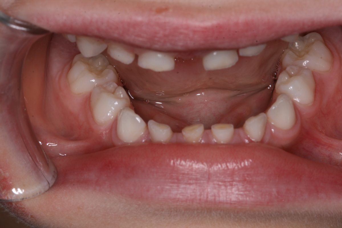 Side view of worn primary teeth with flattened biting surfaces
