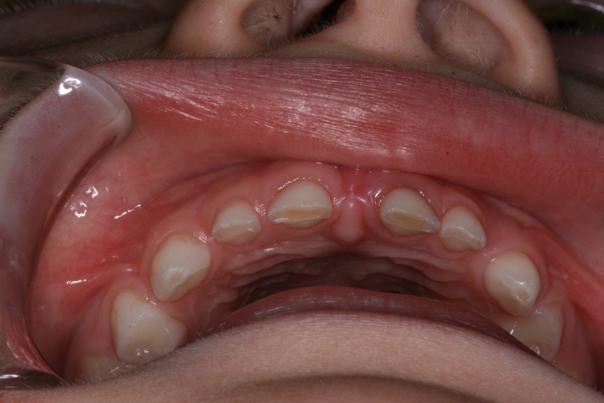 Close-up of lower primary teeth that are worn flat from grinding
