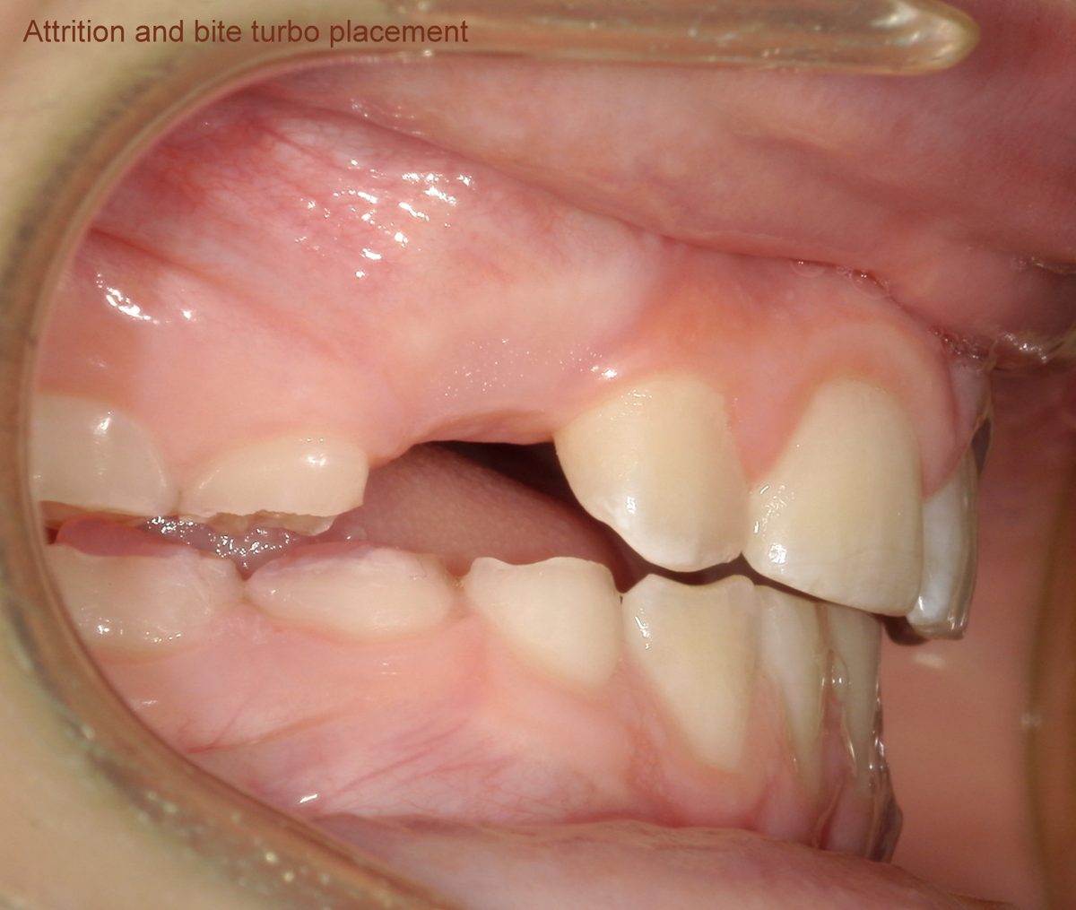Close-up of a composite bite turbo bonded to a primary molar next to worn teeth