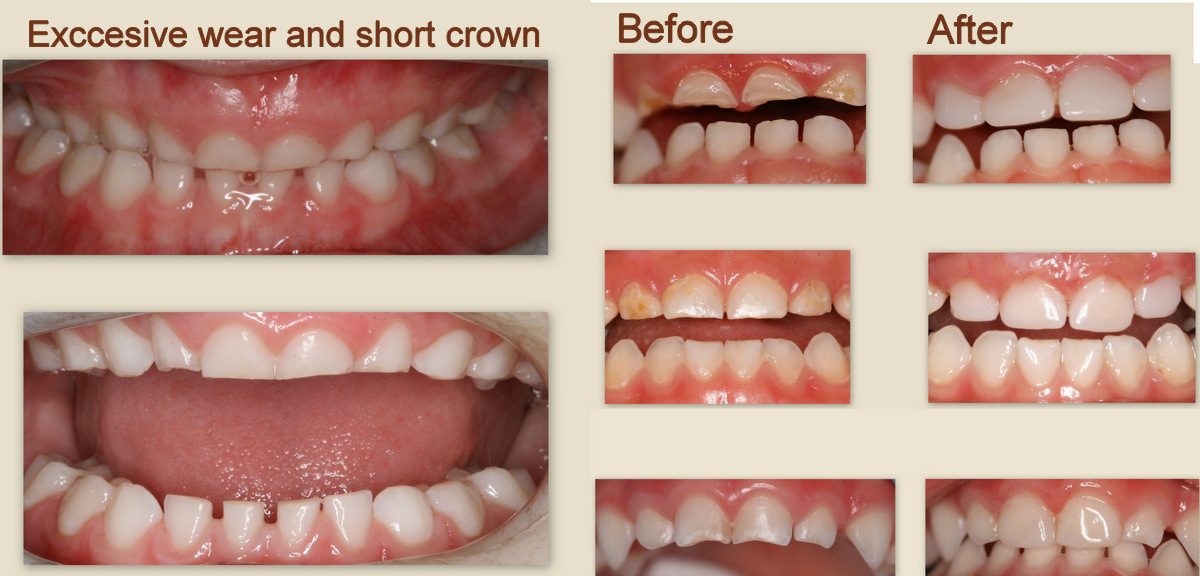 Before-and-after photos of composite restorations rebuilding excessively worn short primary teeth