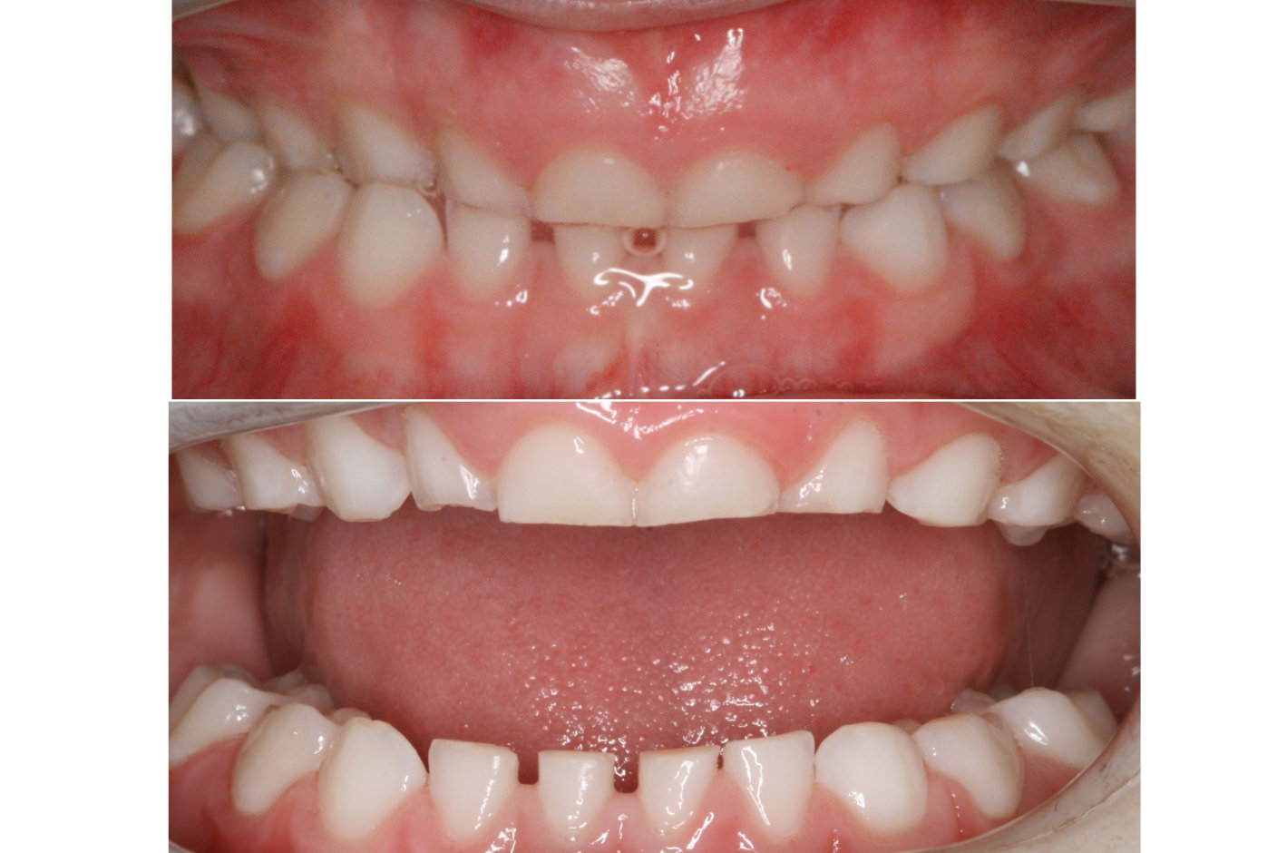 Upper and lower views of teeth showing attrition from bruxism associated with a crossbite