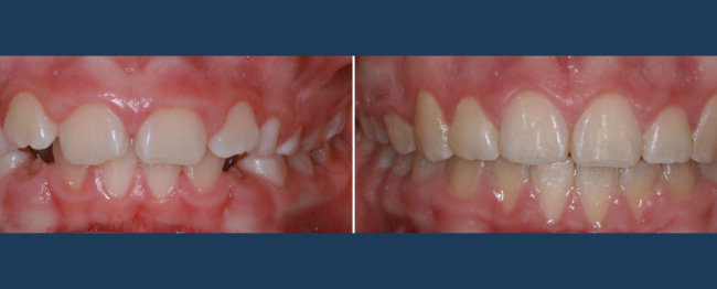 Before-and-after photo showing a patient with a "gummy smile" corrected to show proportional, elongated teeth
