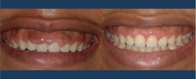 Photo of overgrown or puffy gum tissue around orthodontic braces, or an after-braces gum contouring result