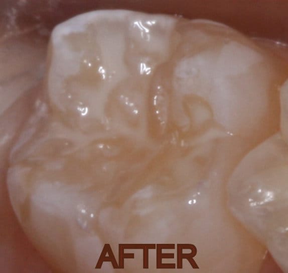 Finished tooth with cured dental sealant mostly invisible after curing.