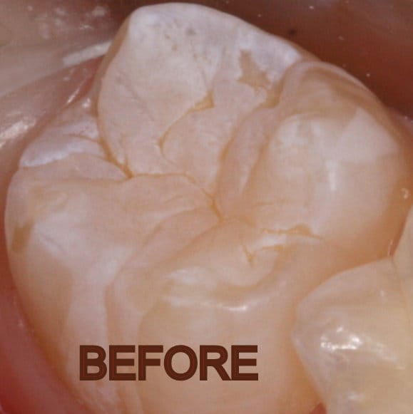 Tooth before dental sealant
