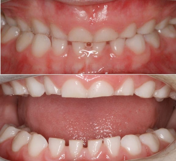 Bruxism: childhood teeth grinding