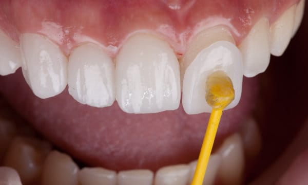 Porcelain veneers service