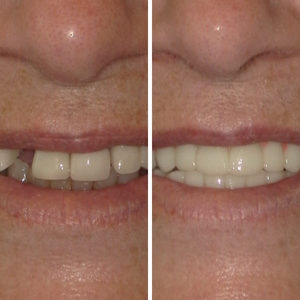 Dental implant — before and after — Case 1