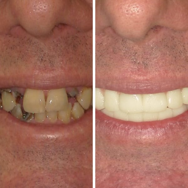Dental implant — before and after — Case 2