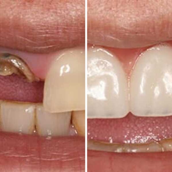 Dental implant — before and after — Case 3