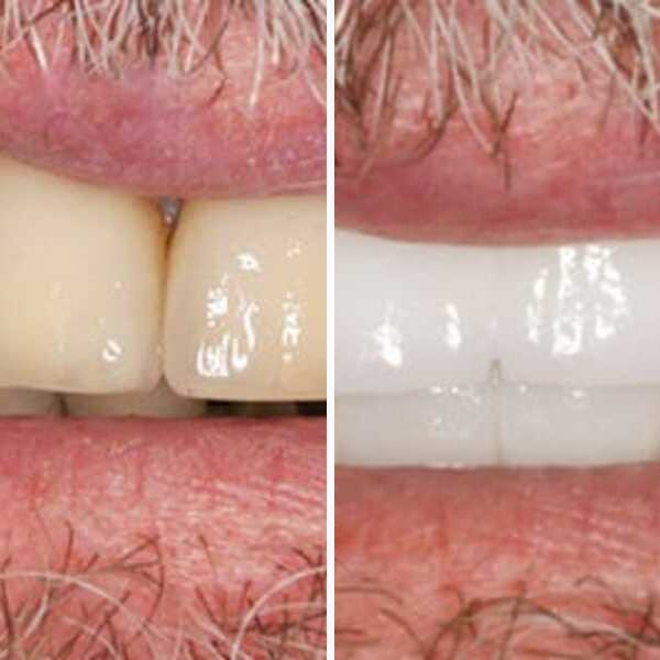 Dental implant — before and after — Case 4