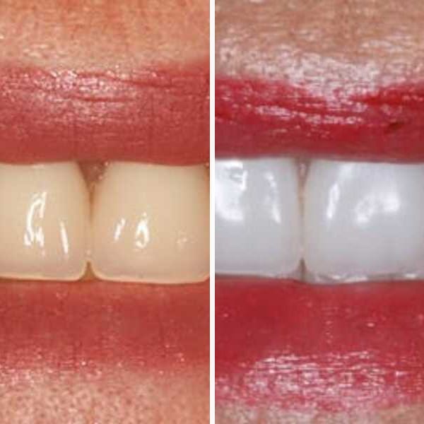 Dental implant — before and after — Case 5