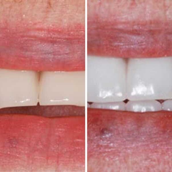 Dental implant — before and after — Case 6