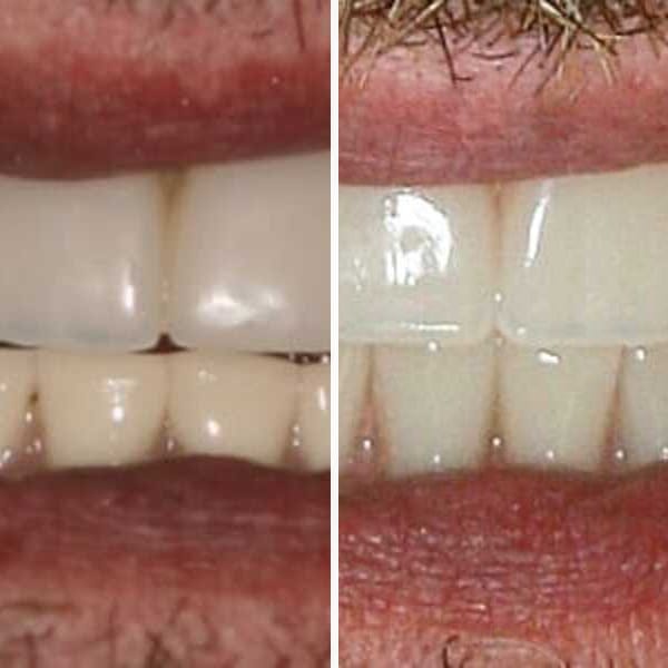 Dental implant — before and after — Case 7