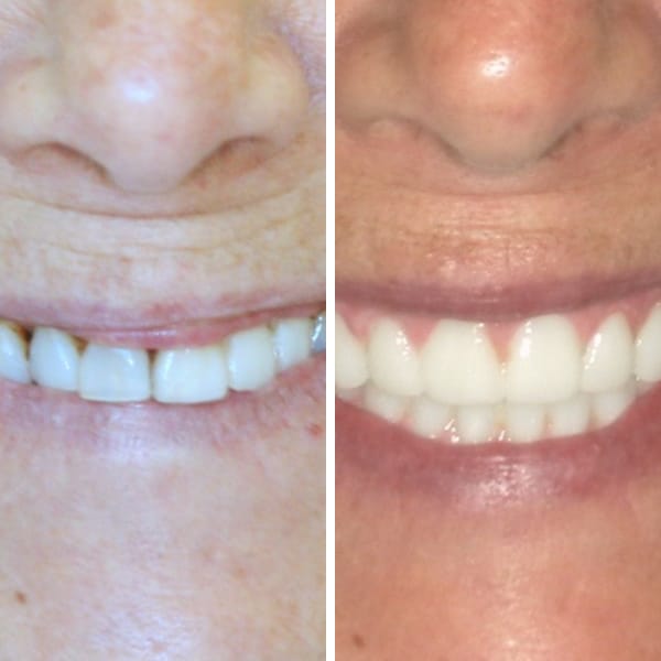 Dental implant — before and after — Case 8