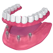 Implant supported denture