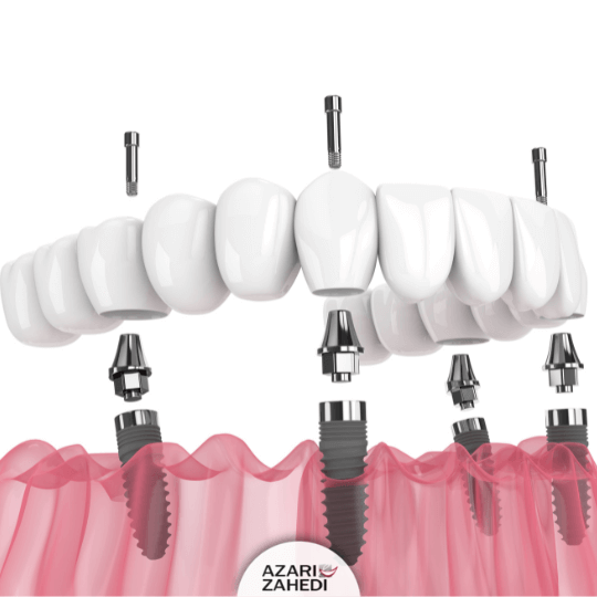 Implant supported denture