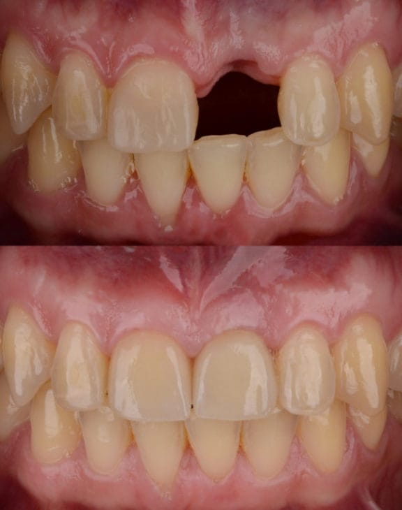 Dental implant evaluation and treatment planning