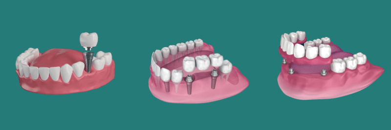 Implant examples