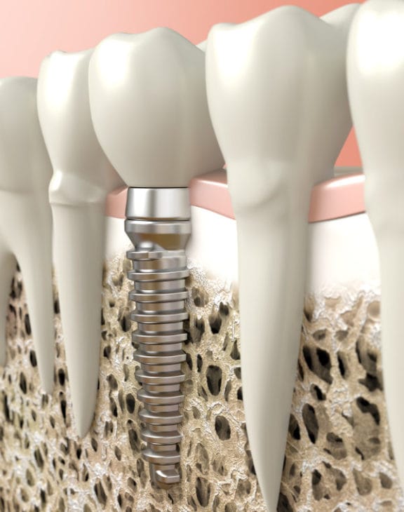 Dental implant consultation and restoration planning