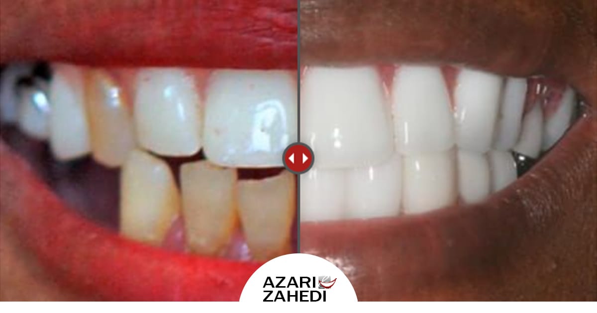 Dental Implants Photo Gallery Jacksonville FL Azari & Zahedi