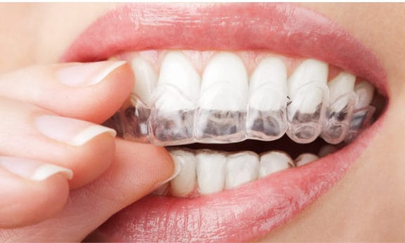 Clear Invisalign aligner used for almost-invisible orthodontic treatment