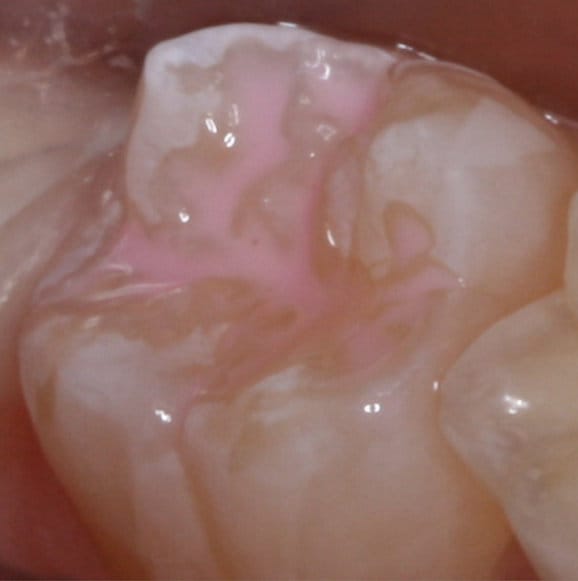 Dental sealant applied.